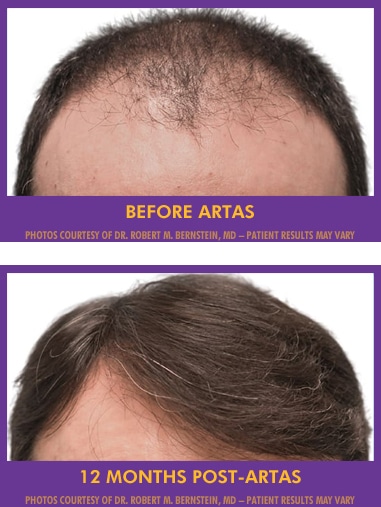 Before and after 12 months post artas | Hair Restoration