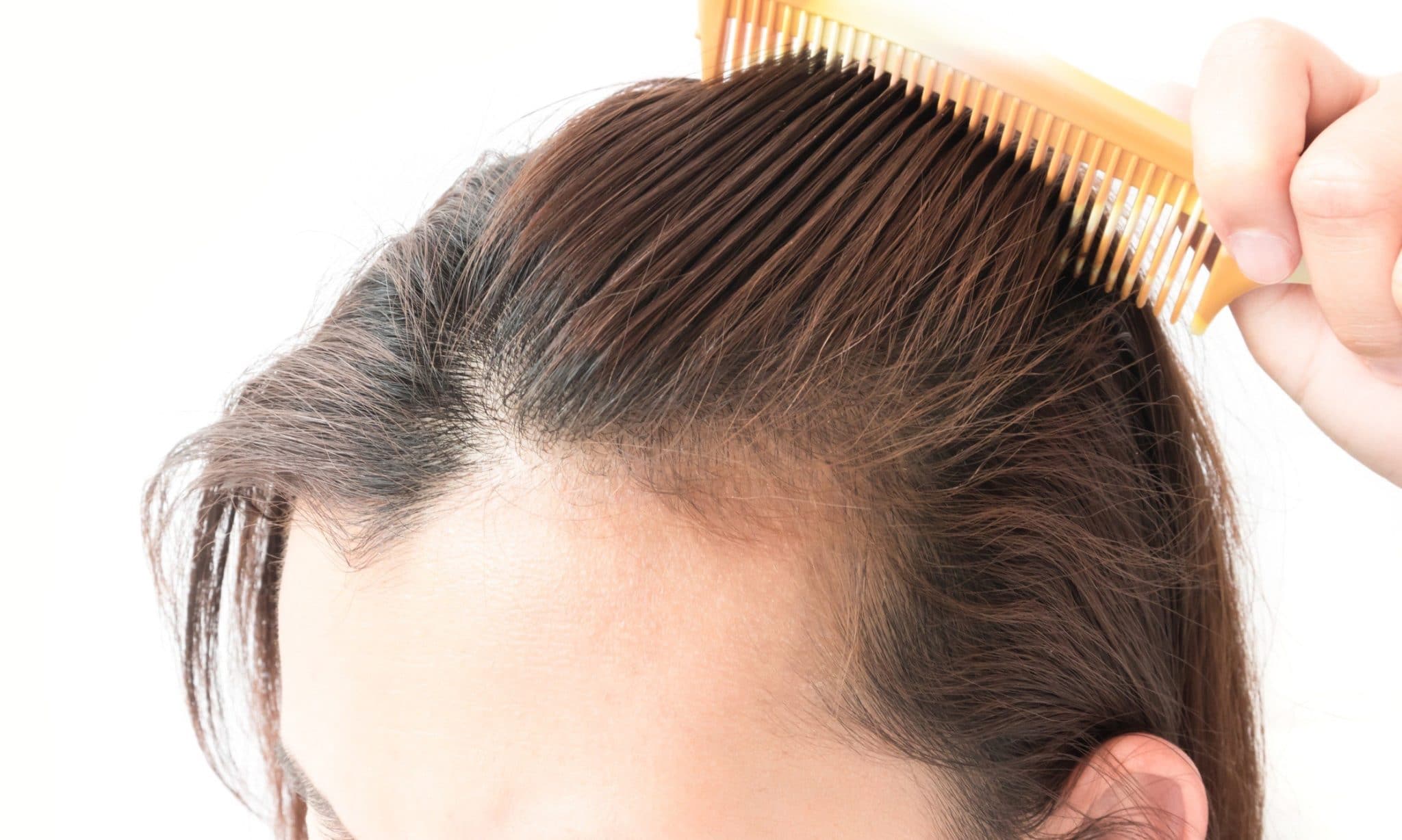 The Truth Behind Female Pattern Hair Loss | West LA Hair Restoration