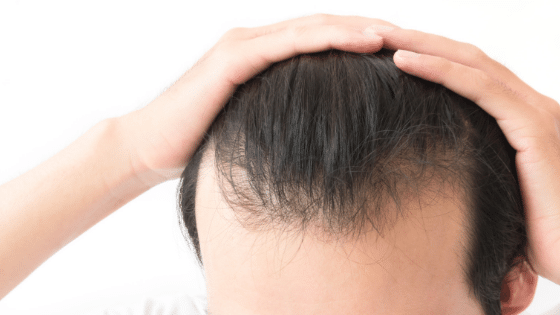 man running both hands through hair | Hair Restoration Treatment