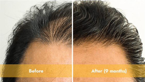 ARTAS Hair Restoration Results in Los Angeles | west la hair experience