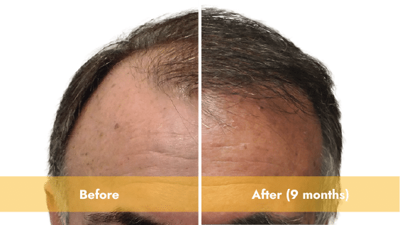 Best Hair Growth Results in Los Angeles | Stem Cell Therapy | A-Cell