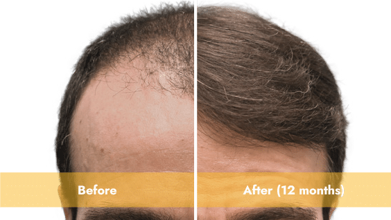 Men's Hair Restoration Results in Los Angeles | west la hair experience | A-cell