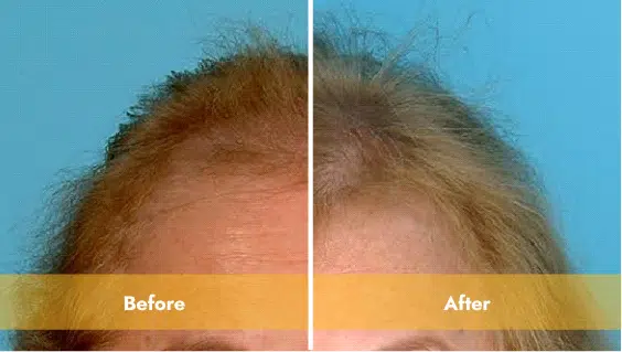 blonde haired woman before and after laser light therapy