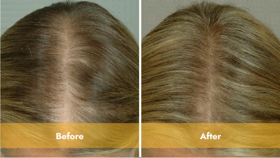 WLAH Website – Before After – Laser-14 blonde haired woman top of head before and after laser light therapy