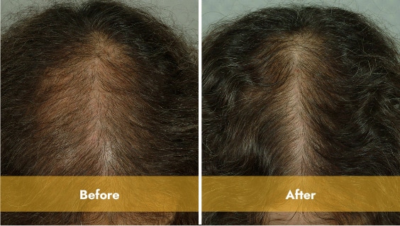 Laser Hair Growth Results for a woman in Los Angeles