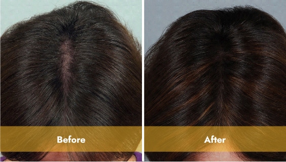 Women's Laser Hair Restoration Results in Los Angeles