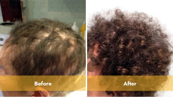 Natural haired woman before and after laser light therapy in Los Angeles