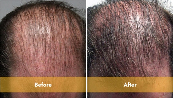 before and after prp treatment