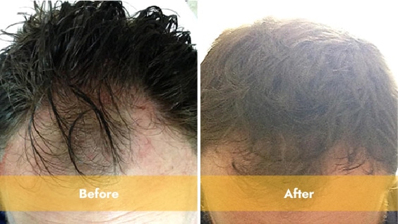 Before and after prp treatment