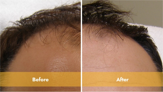 Before and After prp treatment with lasercap
