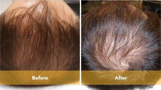 Los Angeles Laser Hair Restoration Treatment Results