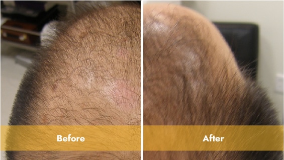 Before and After prp treatment with lasercap