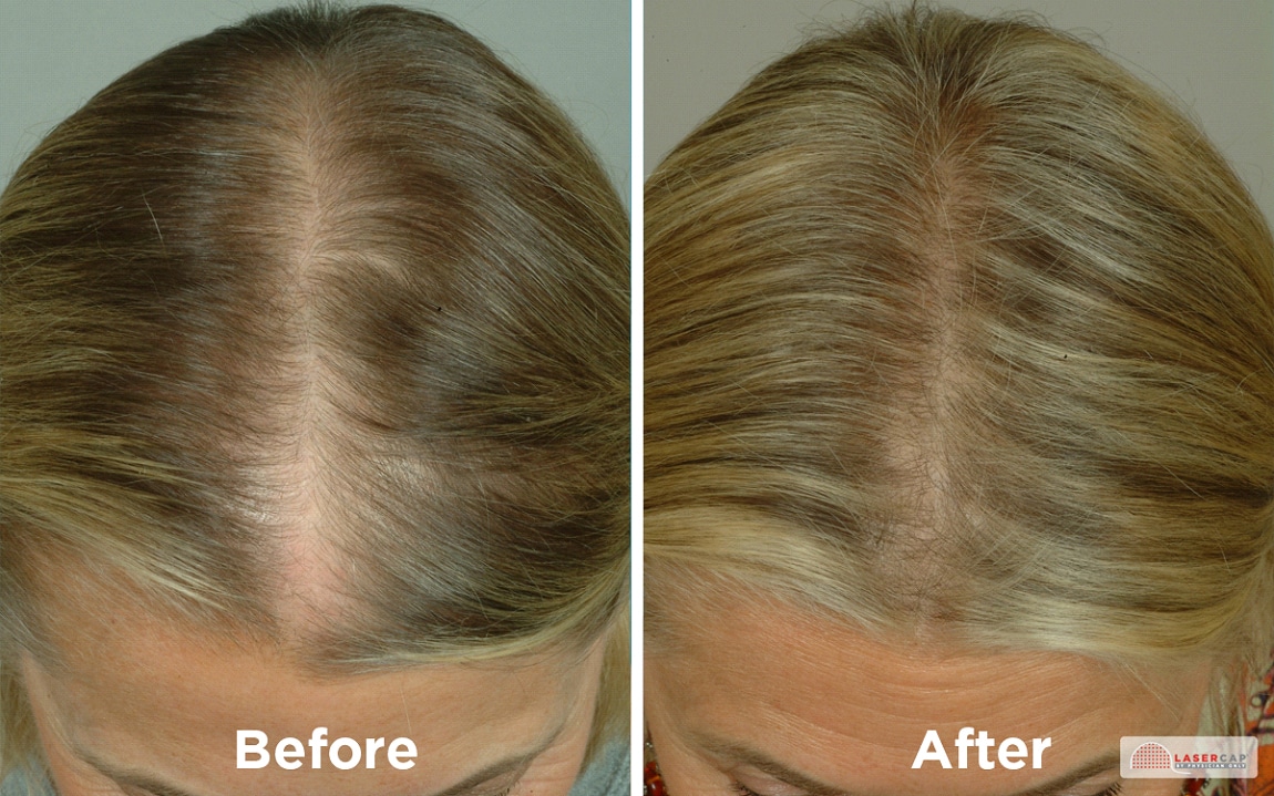 blonde haired woman top of head before and after laser light therapy