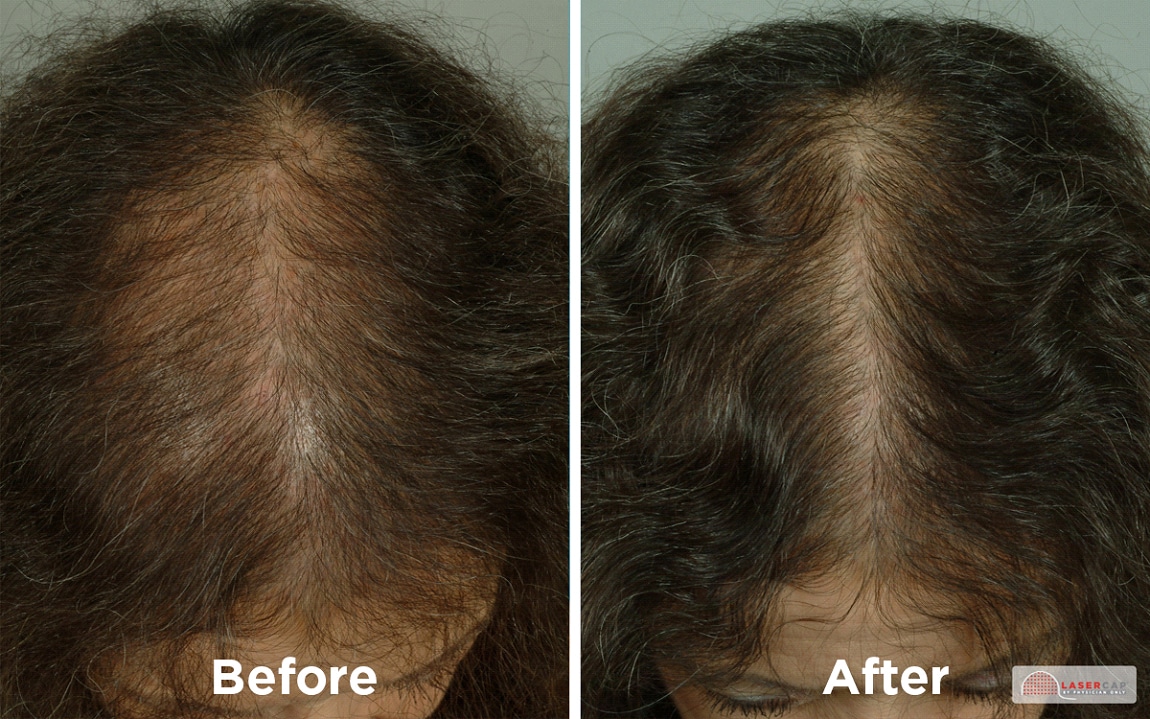 black haired woman top of head before and after laser light therapy