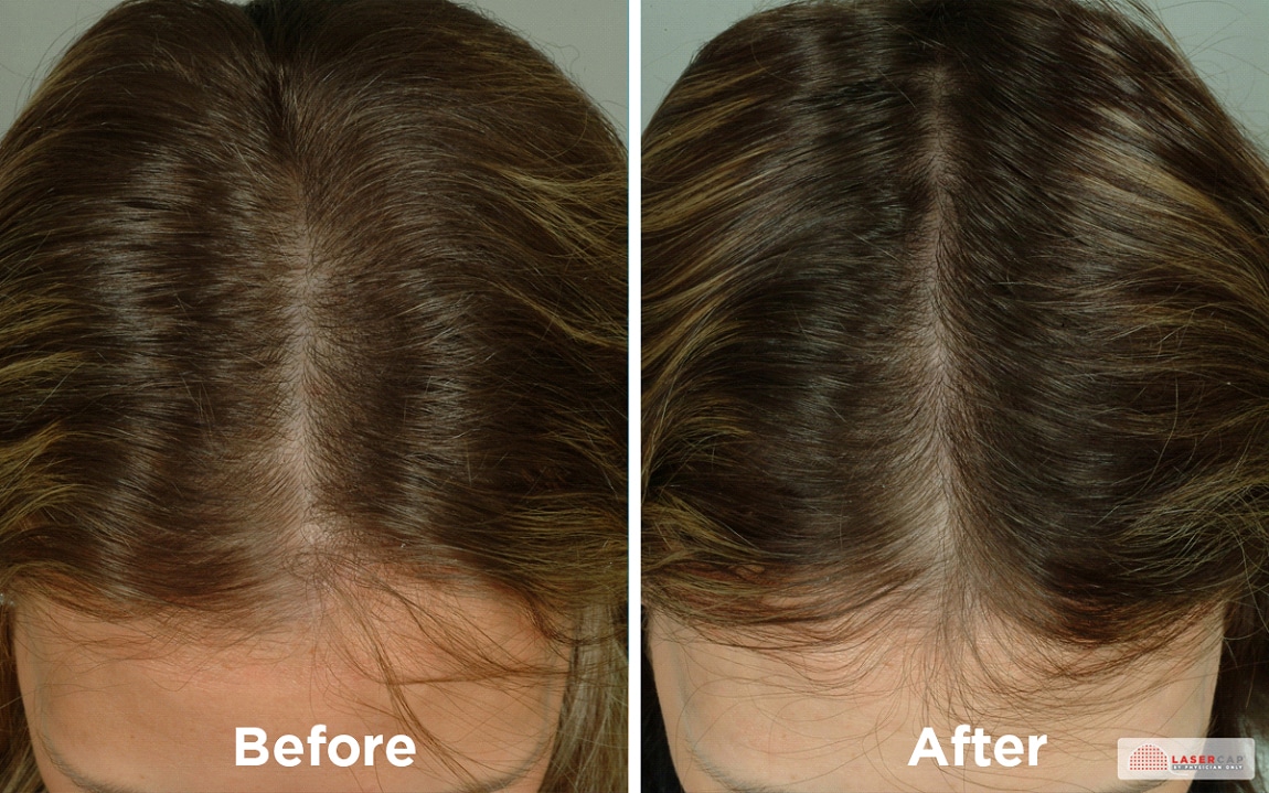brown haired woman top of head before and after laser light therapy