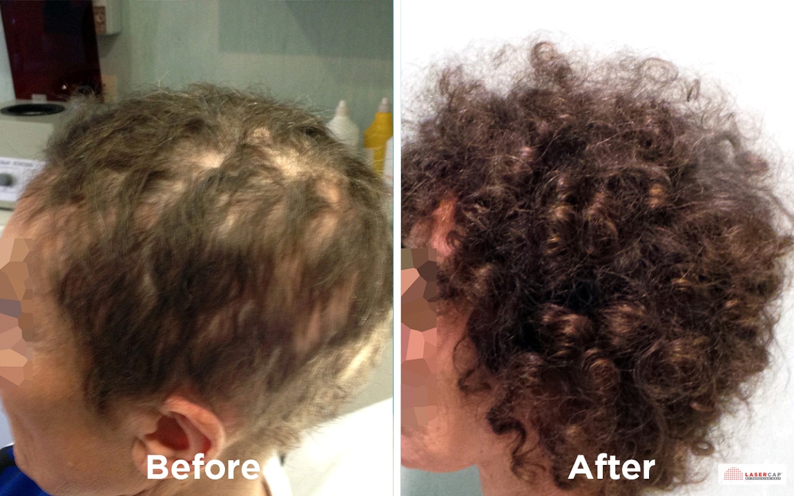 curly haired woman side of head before and after laser light therapy