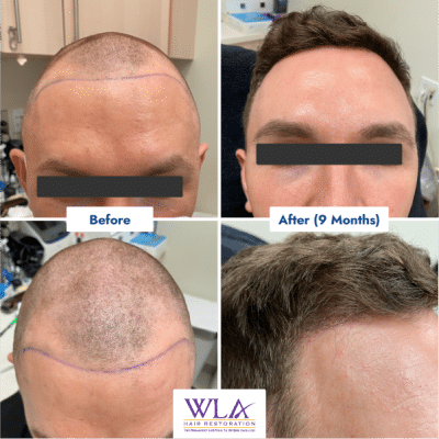 artas robotic hair results