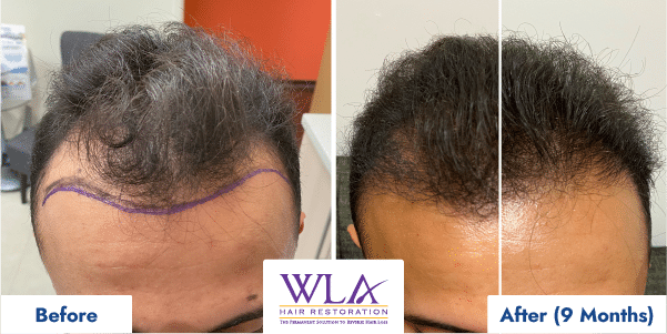 results from Artas hair restoration