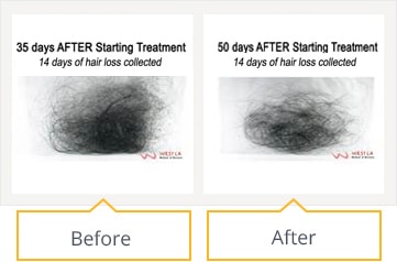Hair Loss Treatment Results