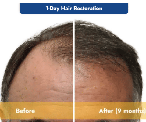 Hair Restoration